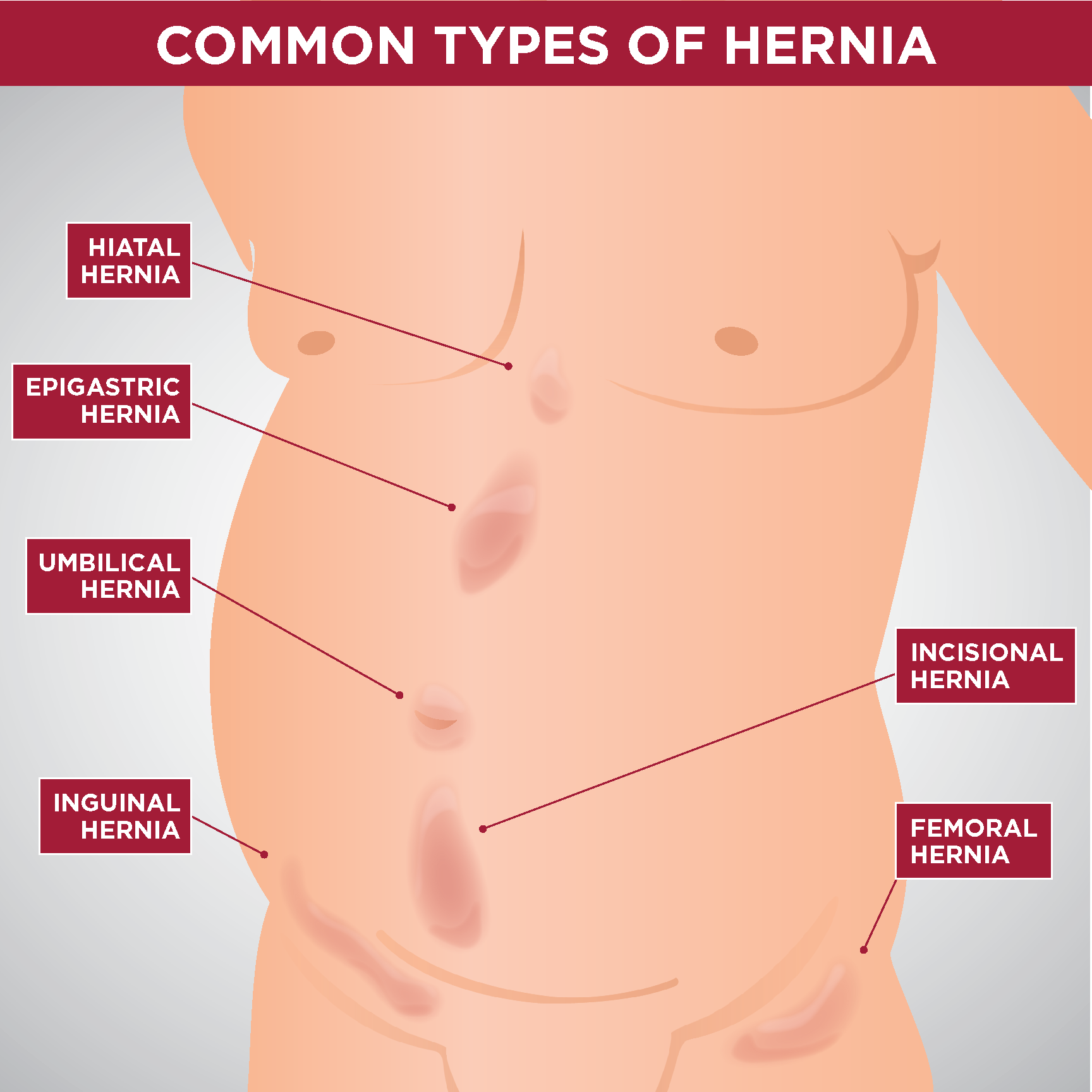 Hernia is when there's an opening in your abdominal wall and your tissue or  intestines bulges into the hole. For post partum moms this i