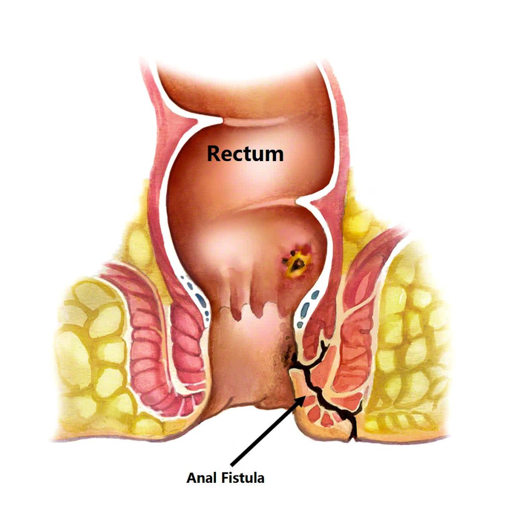 Anal Fistula Treatment