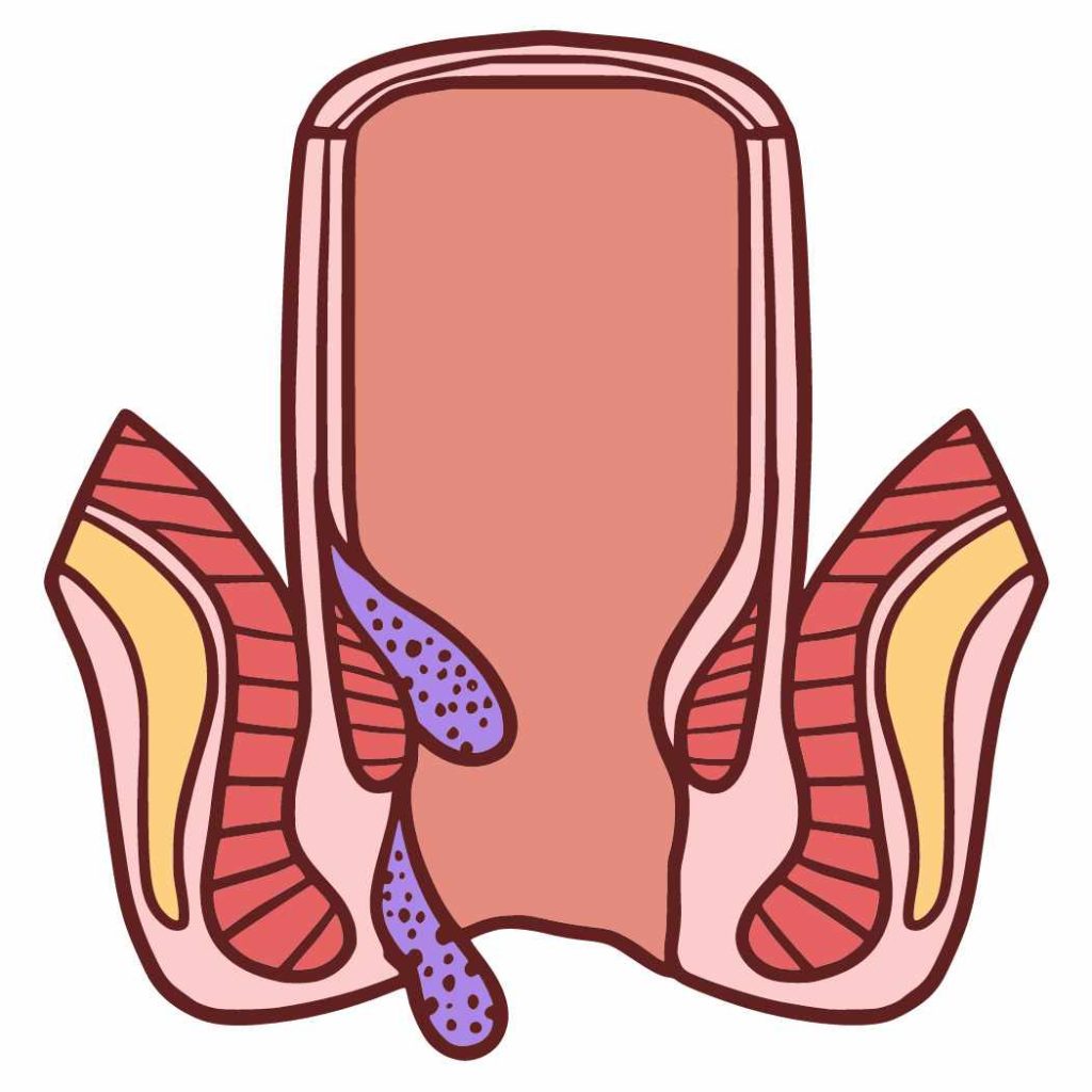 external hemorrhoids