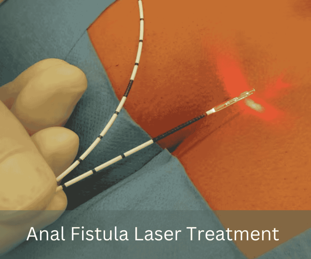 Laser Treatment for Anal Fistula