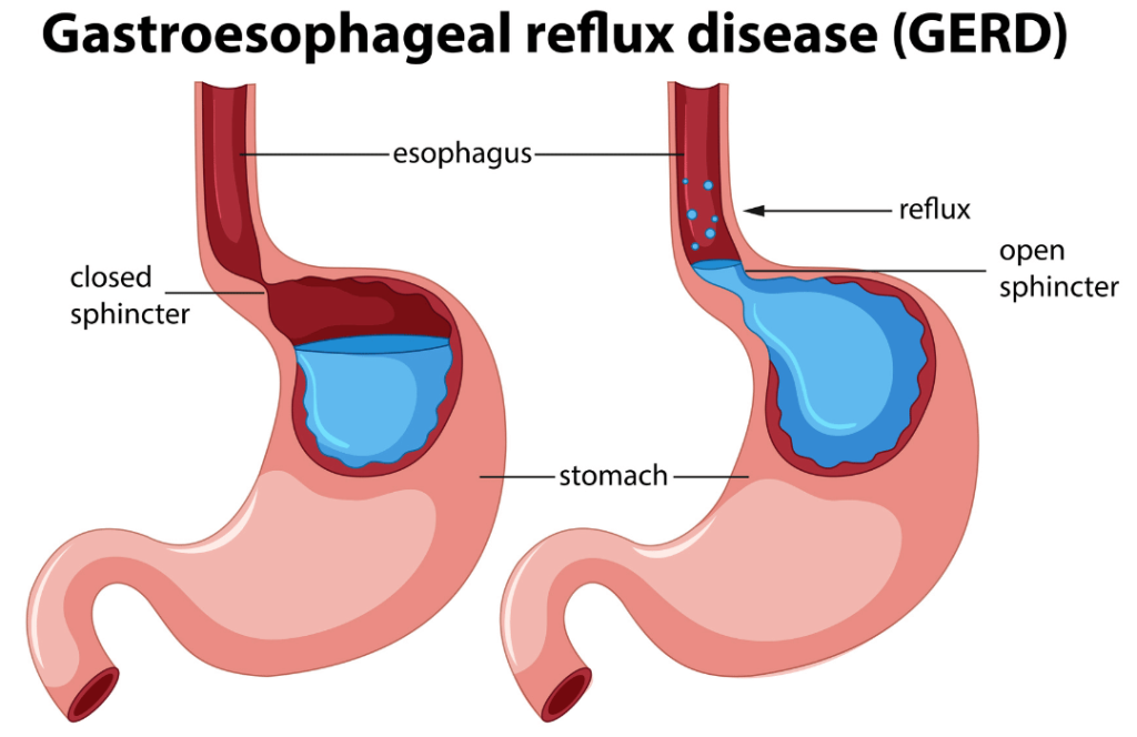 GERD Causes