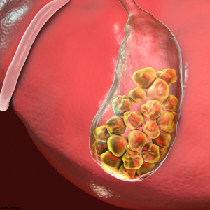 treatment options for gallstones